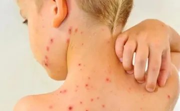 sarampion.jpg_1697385924