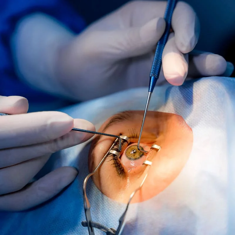 Cirugia-de-Cataratas-Microcirugia-VisionCenter