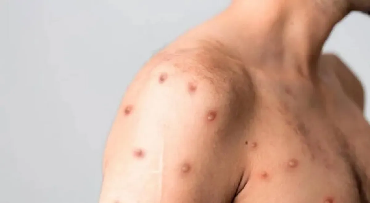 turista-viruela-del-mono-violo-el-aislamiento-disfrutar-sus-vacaciones