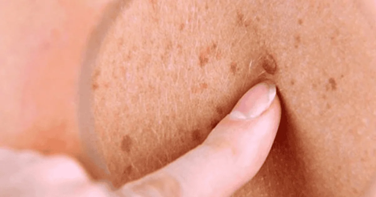 Melanoma: una vacuna experimental mostró beneficios junto con inmunoterapia