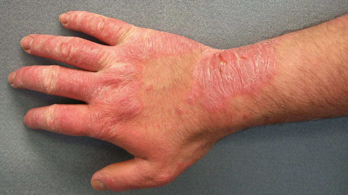 Contact_Dermatitis-1296x728-Header